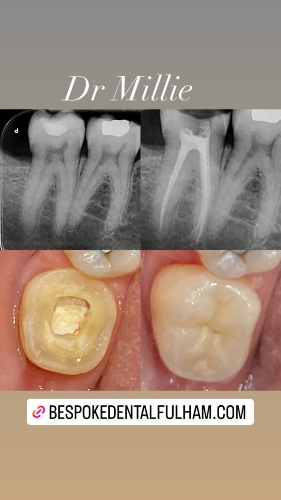 Root canal recovery timeline