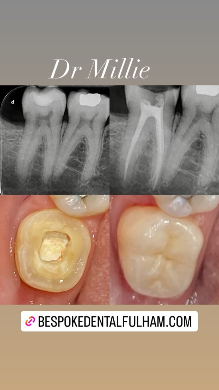 Root canal recovery timeline