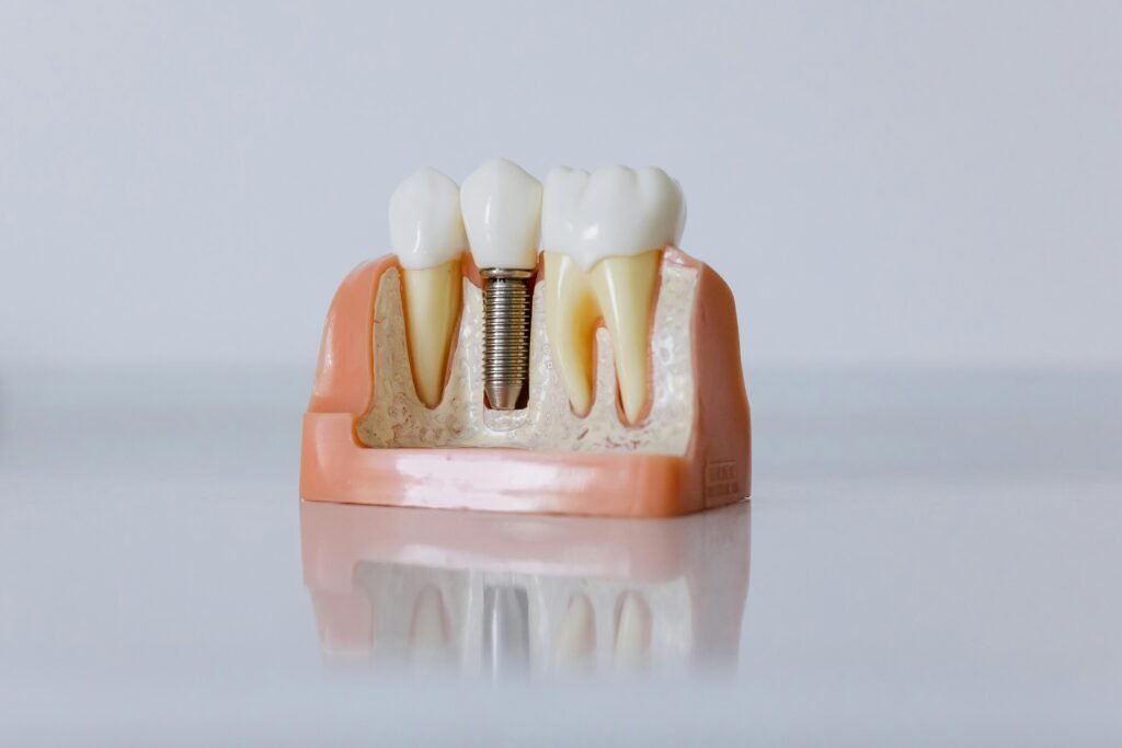 Comparing Crown Types for Root Canal Protection